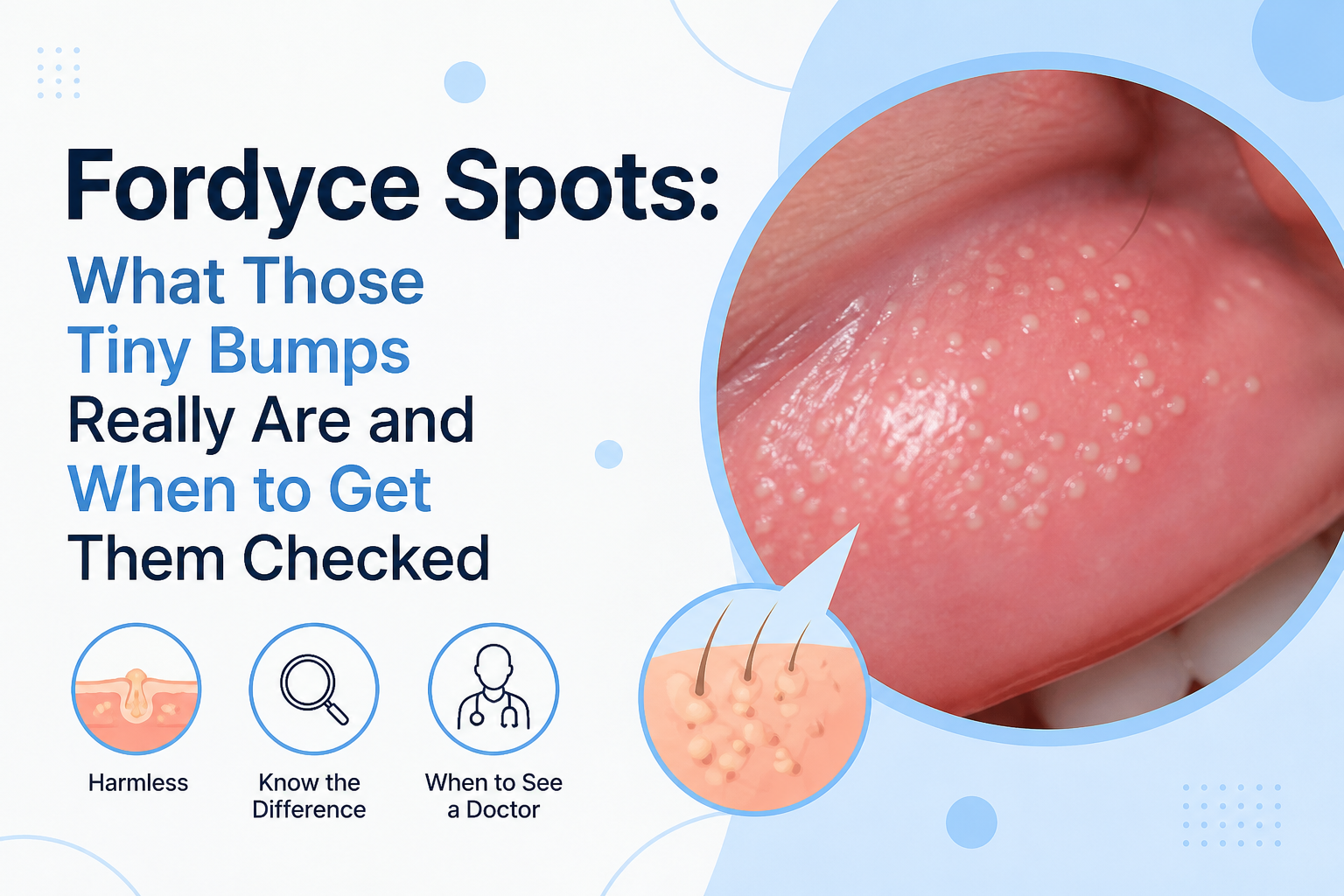Fordyce Spots
